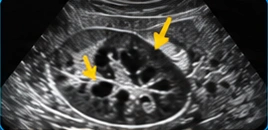 Kidney USG clinical illustration