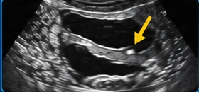 Ureter USG clinical illustration