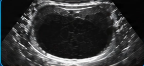 Urinary bladder USG clinical illustration