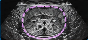 Prostate USG clinical illustration