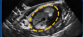 Testis & scrotal USG clinical illustration