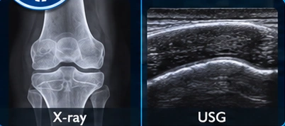 Bone health clinical illustration