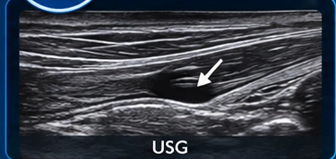 Tendons clinical illustration