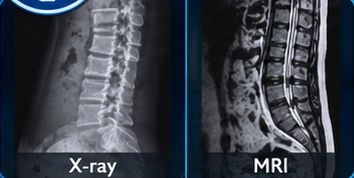 Spine clinical illustration