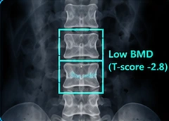 Bone health clinical illustration