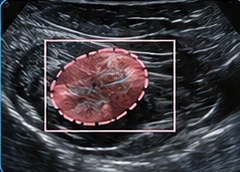 Breast USG clinical illustration