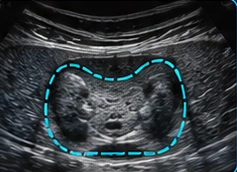 Thyroid USG clinical illustration