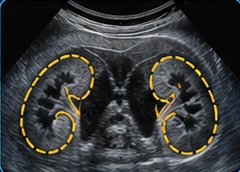 Urinary tract USG clinical illustration